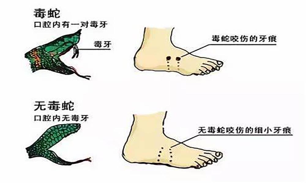 毒蛇咬伤应急处理与急救方法指南